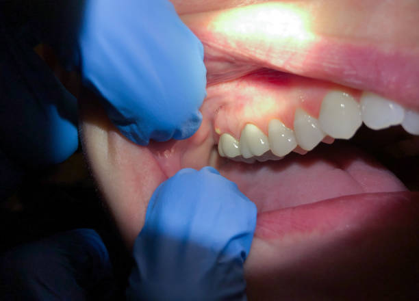 Best Emergency Dental Care for Broken or Chipped Teeth in West Kittanning, PA